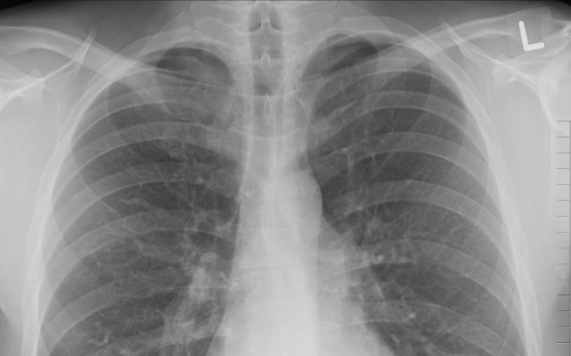 Lung Xray image